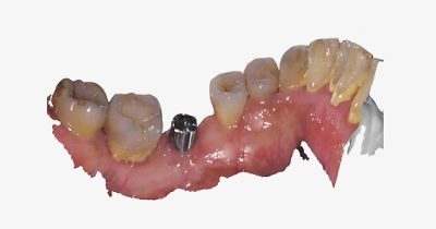 fussen-s6500-wired-ios-implantology-2