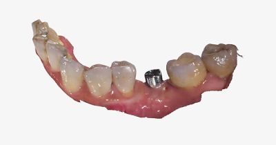 fussen-s6500-wired-ios-implantology-3