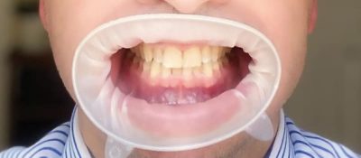 Live Composite Bonding Masterclass: Watch & Learn from the Expert - Image 6