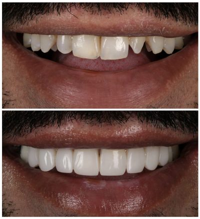 Live Free Hand Veneers Masterclass: Watch & Learn from the Expert - Image 2