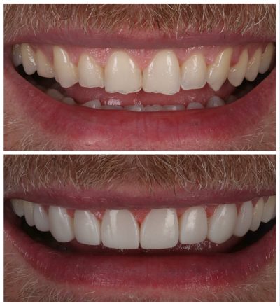 Live Composite Bonding Masterclass: Watch & Learn from the Expert - Image 2