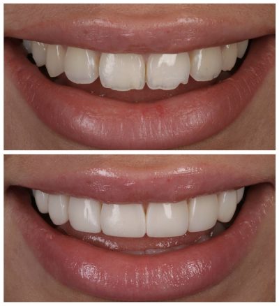 Live Free Hand Veneers Masterclass: Watch & Learn from the Expert - Image 3