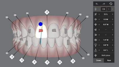 aligner-protocol-treatment-plan