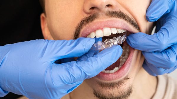 Clear Aligner Protocol | MediMatch Dental Laboratory