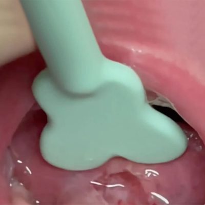 tongue-guide-infant-pro-armor-dental