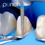 PUNCH – Knock Out Rubber Dam Isolation