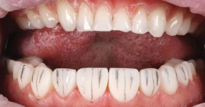 Live Free Hand Veneers Masterclass: Watch & Learn from the Expert - Image 6