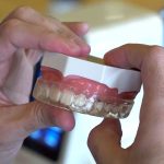 injection-veneers-course