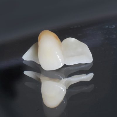 Mastering Fixed Bridges: From Preparation to Placement - Image 3